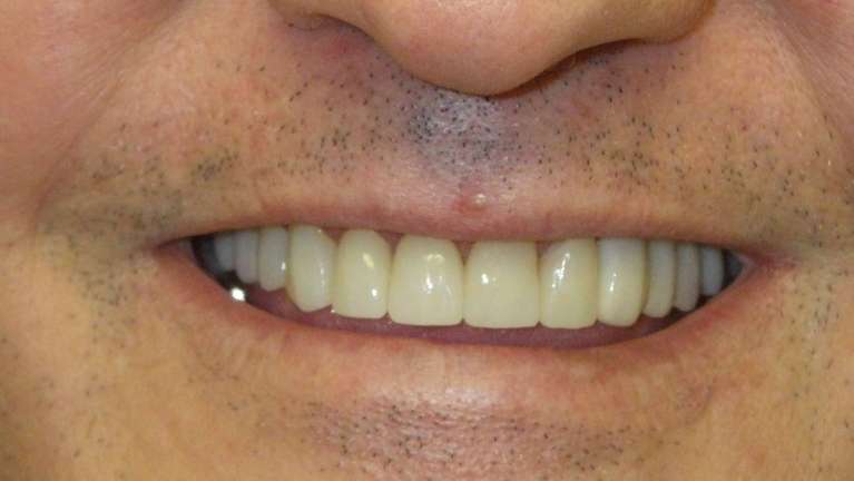 Full-Upper-Crown-Restorations-After-Image