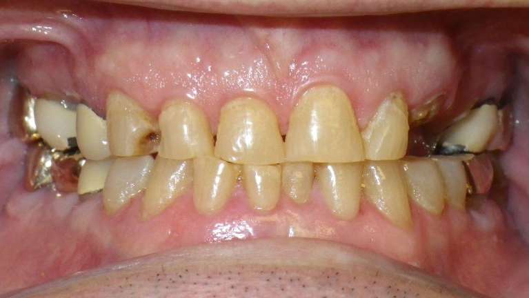 Full-Upper-Crown-Restorations-Before-Image