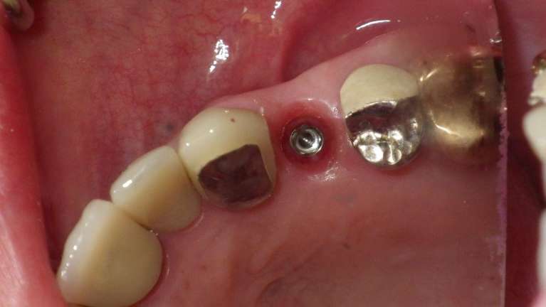 Implant-Crown-Replacement-Before-Image
